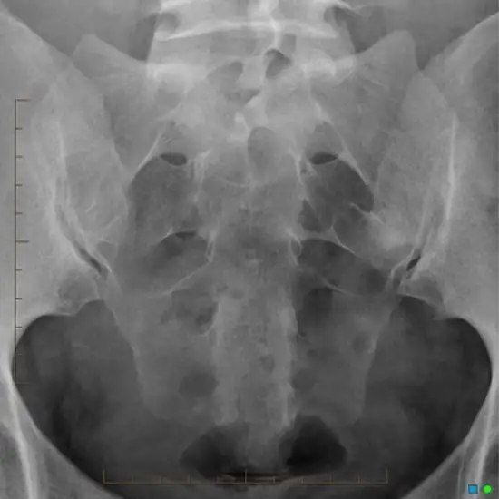 x-ray both si joints ap and lateral view test